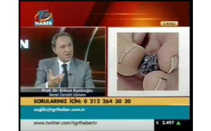 Prof. Dr. Erhun Eyüboğlu,Reflü tedavisi,Reflü cerrahisi,Reflü hastalığı,Erhun Eyüboğlu