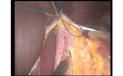 SILS yöntemi,Prof. Dr. Erhun Eyüboğlu,Erhun Eyüboğlu