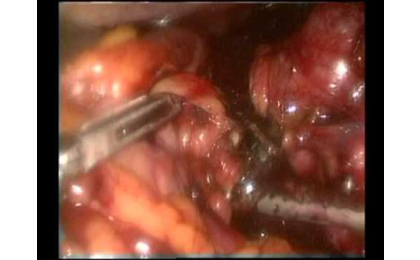 Prof. Dr. Erhun Eyüboğlu,Erhun Eyüboğlu,Mide Cerrahisi