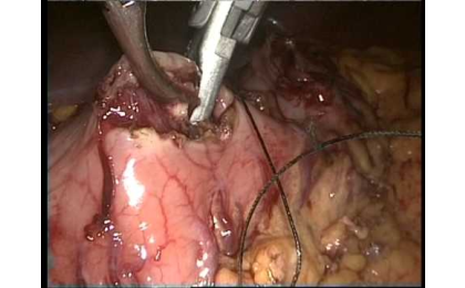 Laparoskopik,Laparoskip Cerrahi,Prof. Dr. Erhun Eyüboğlu,Erhun Eyüboğlu