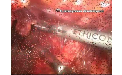 Prof.Dr. Erhun Eyüboğlu,Erhun Eyüboğlu,Laparoskopi,D2 Lenf Nodu Disseksiyonu