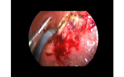 TEM Olguları,TEM Yöntemi,Prof. Dr. Erhun Eyüboğlu