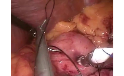 morbid obezite,gastrik bypass,metabolik cerrahi,Roux-en Y gastrik bypass,şişmanlık