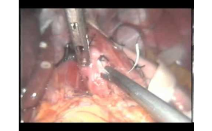 prof-dr-erhun-eyuboglu-laparoskopik-toupet-fundoplikasyonu