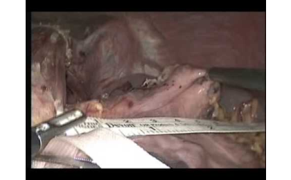 prof-dr-erhun-eyuboglu-laparoskopik-floppy-nissen-fundoplikasyonu