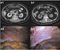 Peritoneal Karsinomatoz Nasıl Teşhis Edilir?