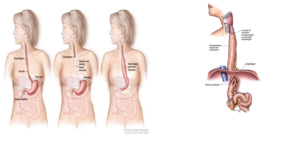 Özefagus Kanserinde Tedavi